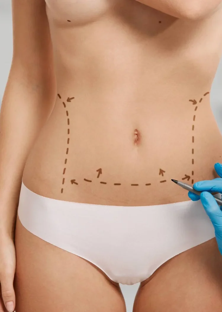woman-marked-out-cosmetic-surgery (1) woman-marked-out-cosmetic-surgery (1)