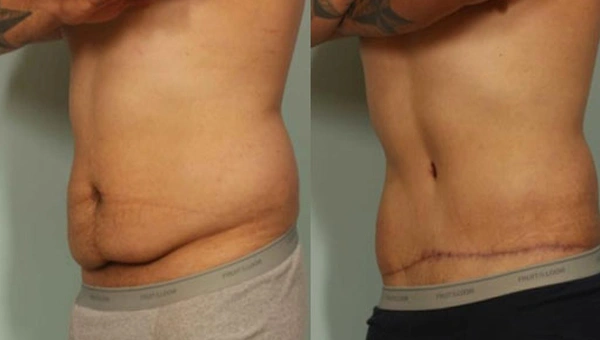 Tummy Tuck Surgery in Delhi