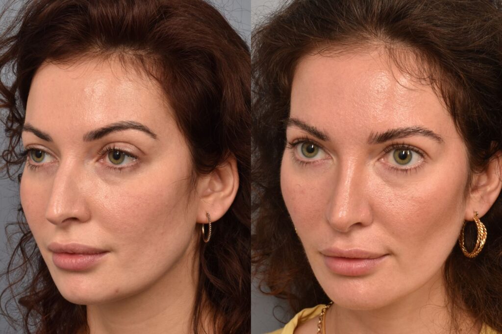 Buccal Fat Removal Surgery in Delhi