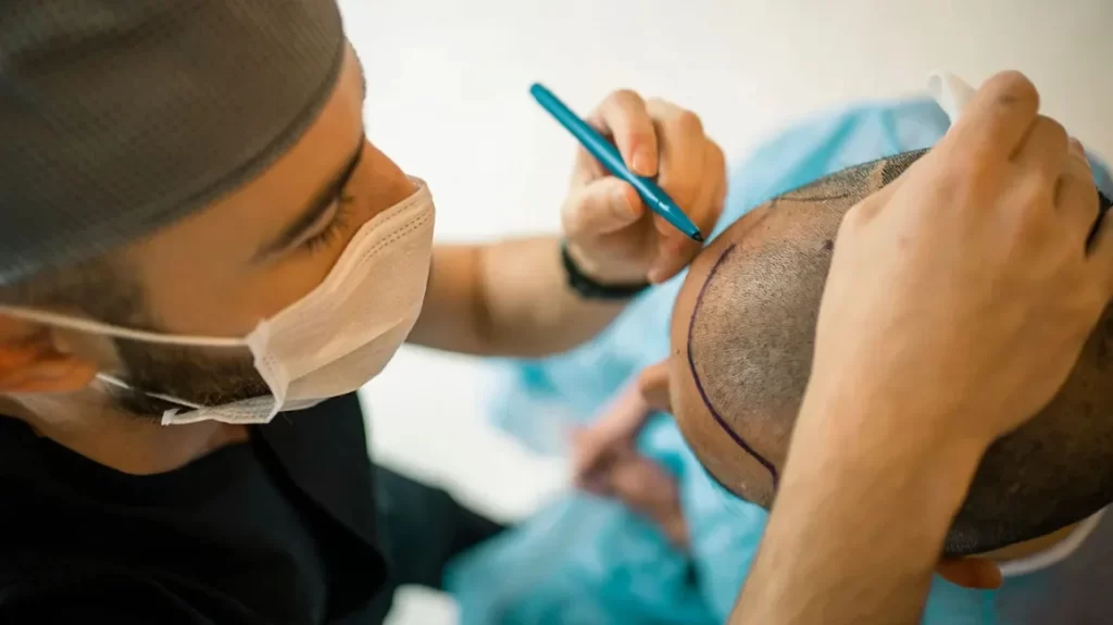 GFC Hair Treatment in Delhi by Dr Vivek Gupta