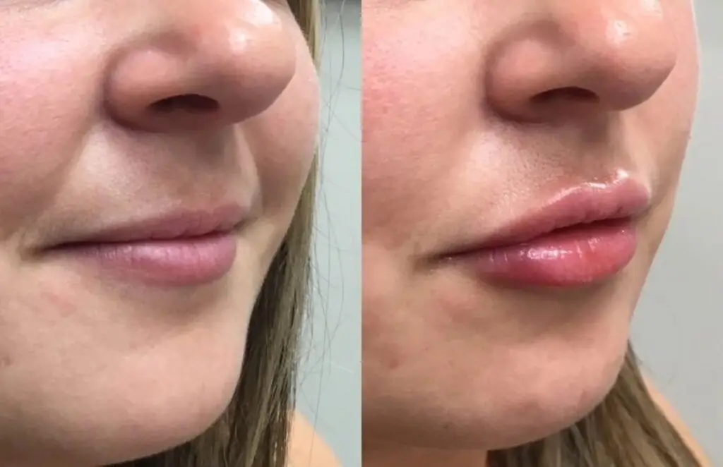 Dermal Fillers Treatment in Delhi