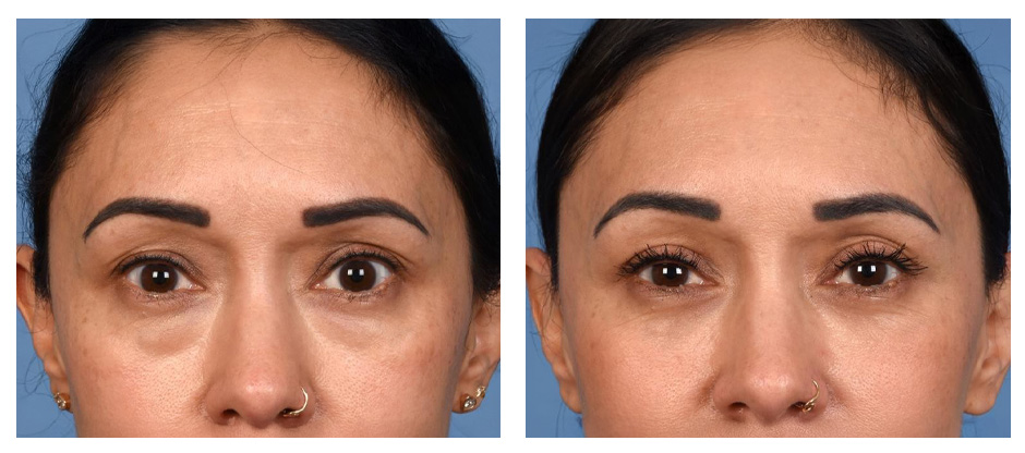 Eyelid Surgery in Delhi