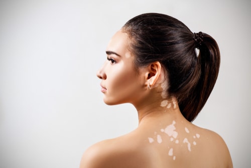 Vitiligo Treatment in Delhi