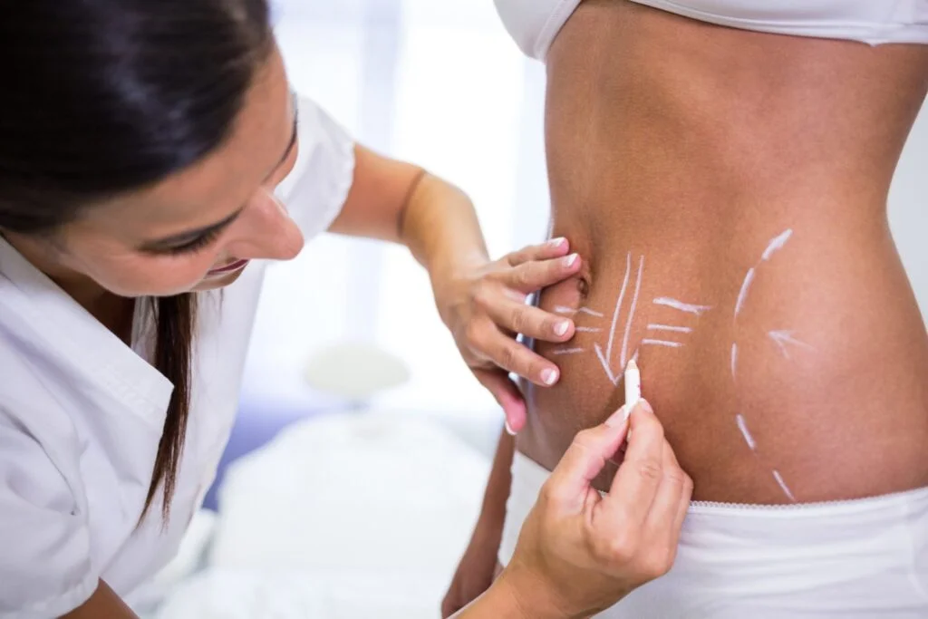 Liposuction Surgery in Delhi